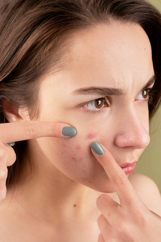Mistérios da Acne: Uma Jornada para uma pele sem cravos e espinhas
